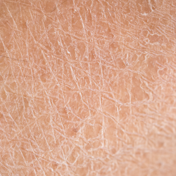 Dry skin