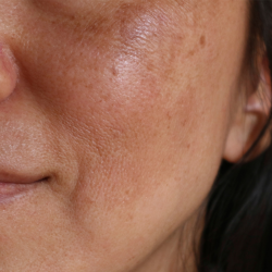 Melasma