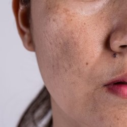 Pigmentation