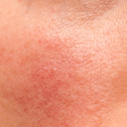 Rosacea